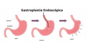 Gastroplastia Endoscópica em Porto Alegre - Urgegastro