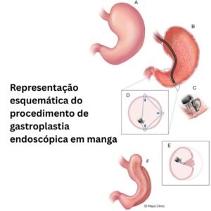 urgegastro-dr-nelson-coelho-gastroplastia endoscópica em manga