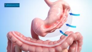 Gastroplastia Endoscópica: Redução de Estômago Sem Cirurgia