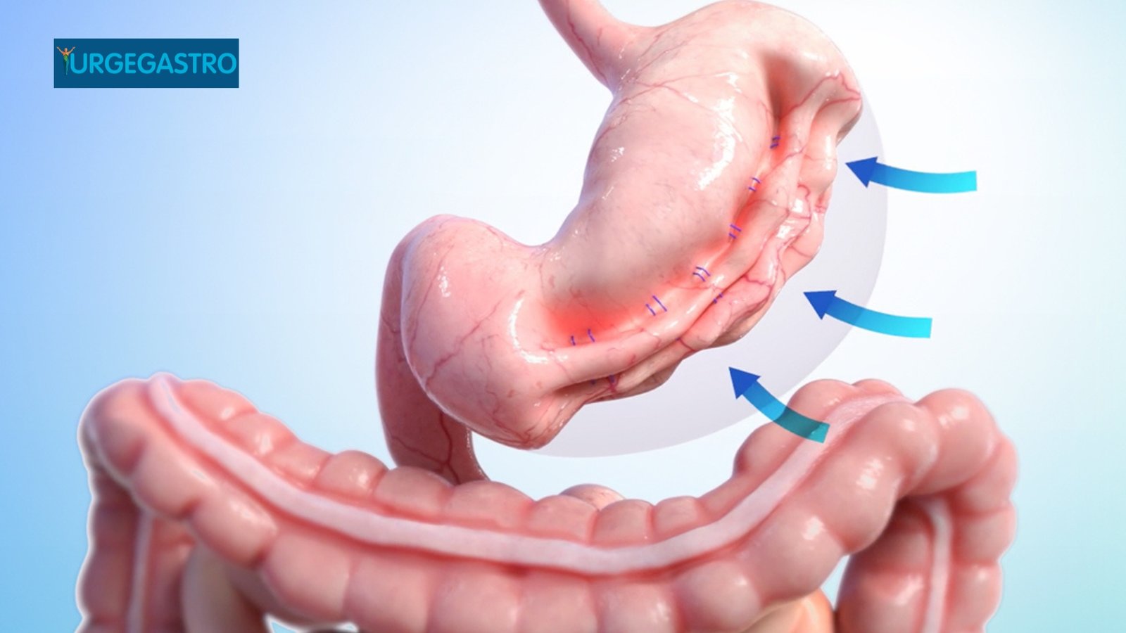 Gastroplastia Endoscópica: Redução de Estômago Sem Cirurgia