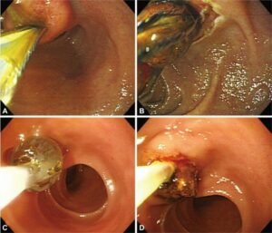 Visão endoscópica da remoção de cálculos do ducto biliar comum (CBD) utilizando apenas endoscopia.
