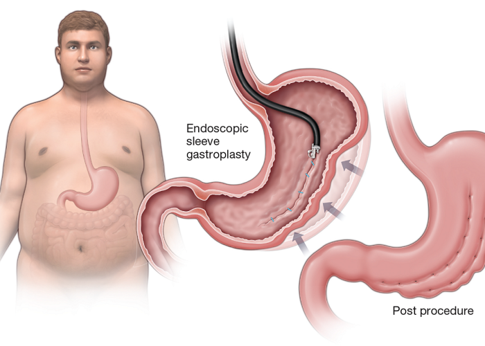 urgegastro-gastroplastia-endoscópica-em-porto-alegre urgegastro-gastroplastia-endoscópica-em-porto-alegre